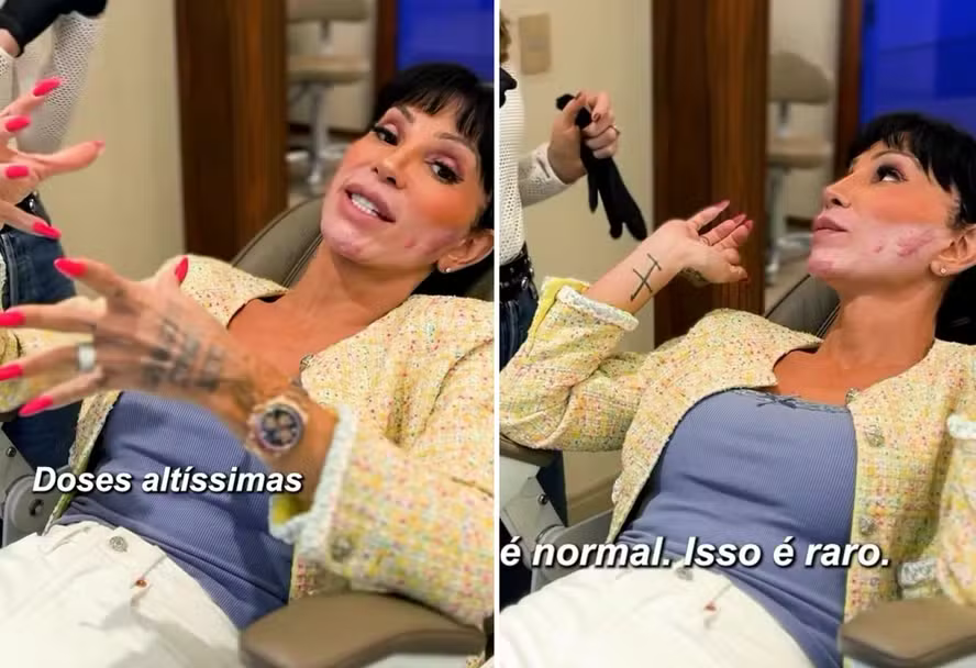 Maya Massafera mostra reação no rosto por uso excessivo de hormônios – Gay1