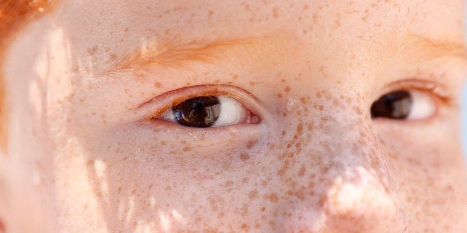 Reflexo branco nos olhos: entenda condição que assusta pais