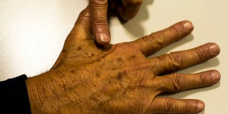 Desinformação sobre câncer de pele afeta diagnóstico, diz instituição