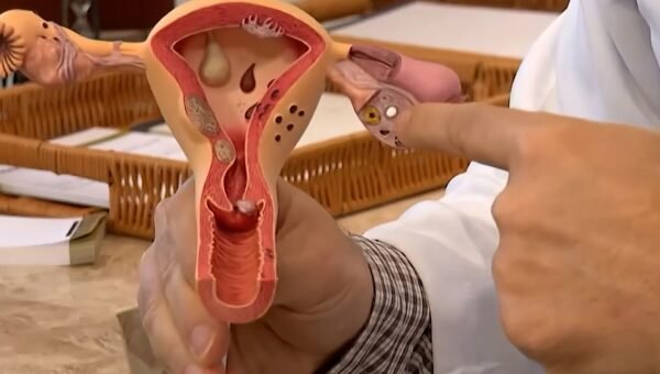 Aberta chamada pública para pesquisas sobre endometriose