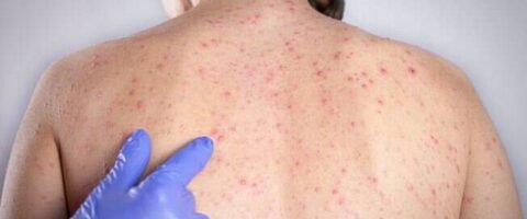 Estado de São Paulo confirma 23 casos de sarampo; 16 não se vacinaram