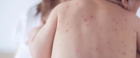 Estado de São Paulo reforça necessidade de vacinação contra o sarampo