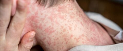 Sarampo: entenda sinais e sintomas, riscos e quando se vacinar