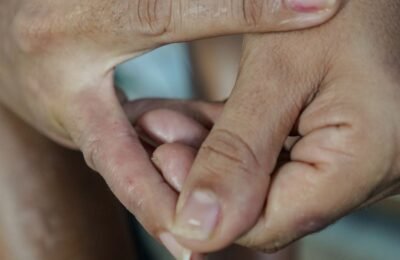 Dermatite atópica impacta pele, sono e autoestima: saiba como tratar