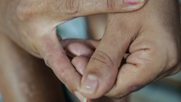 Dermatite atópica impacta pele, sono e autoestima: saiba como tratar