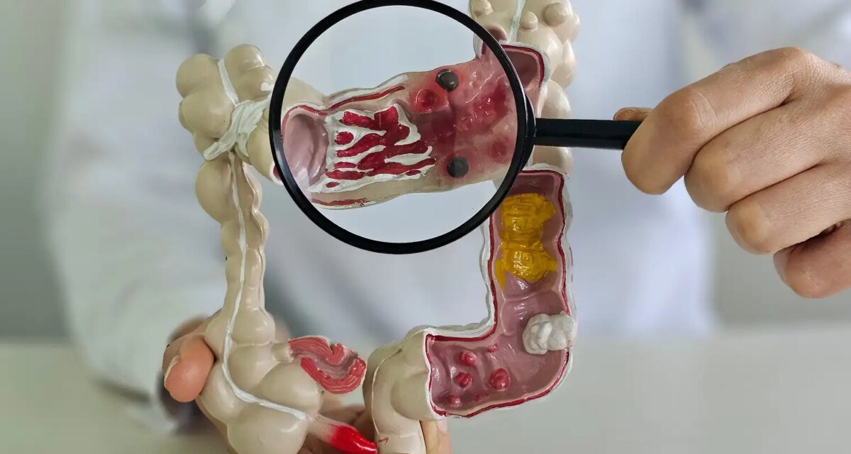 Em 13 anos, doença inflamatória intestinal cresce 5 vezes no Brasil