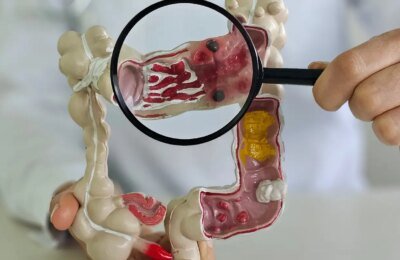Em 13 anos, doença inflamatória intestinal cresce 5 vezes no Brasil