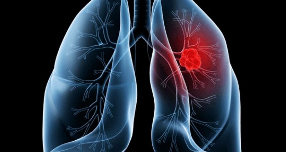 Saiba o que é adenocarcinoma pulmonar, câncer que atinge o Papa Leão XIV