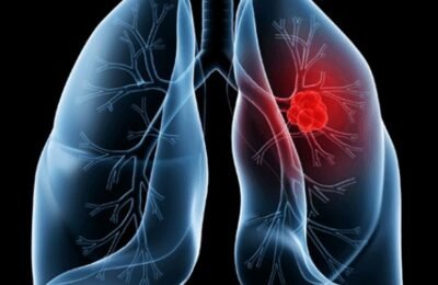 Saiba o que é adenocarcinoma pulmonar, câncer que atinge o Papa Leão XIV
