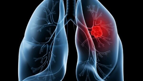 Saiba o que é adenocarcinoma pulmonar, câncer que atinge o Papa Leão XIV